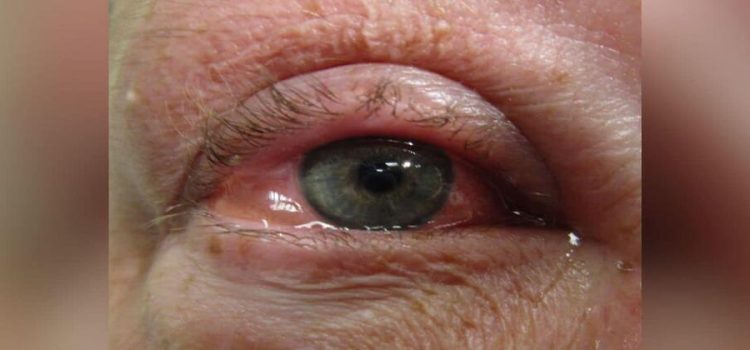 Incrementan casos de conjuntivitis en Sonora este año